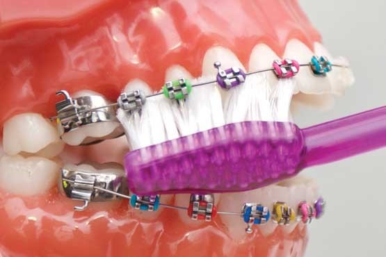 نکات مراقبت های بعد از ارتودنسی چیست؟
