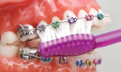 نکات مراقبت های بعد از ارتودنسی چیست؟