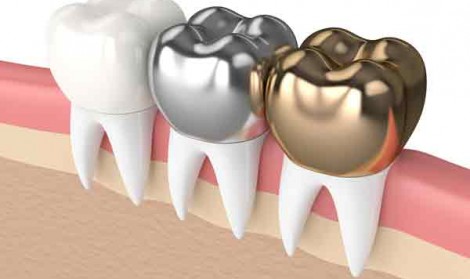 بهترین روکش دندان