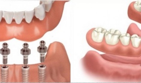اوردنچر دندان چیست؟