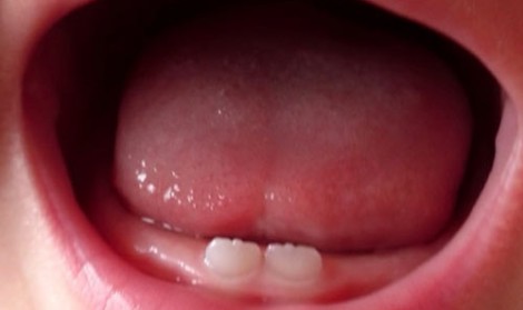 ترمیم دندان شیری