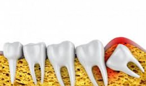 جراحی دندان نهفته