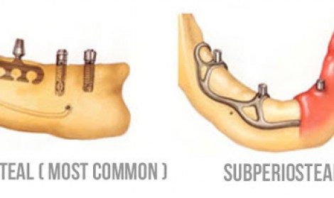 ایمپلنت های ساب پریواستیل