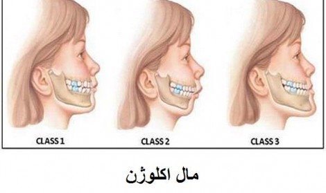 مال اکلوژن چیست؟ 