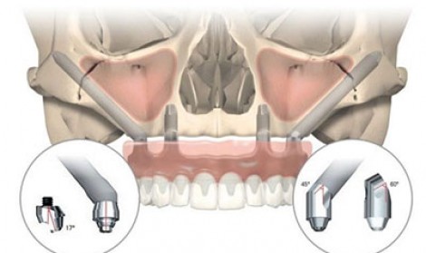 ایمپلنت زیگوماتیک 