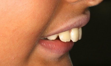 دندان خرگوشی