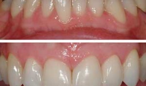 ردیف و مرتب کردن دندان