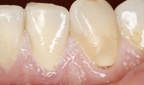 علت سفید شدن لثه‌ها