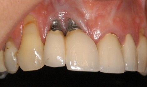 حساسیت به فلز ایمپلنت