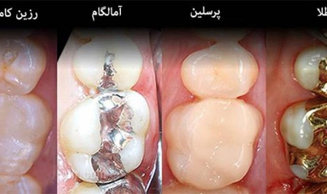 پر کردن دندان با مواد