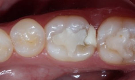 پانسمان موقت دندان