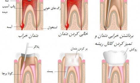 مراحل عصب کشی دندان‌