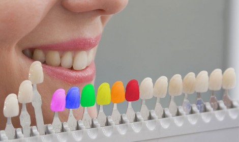 انواع کامپوزیت دندان 